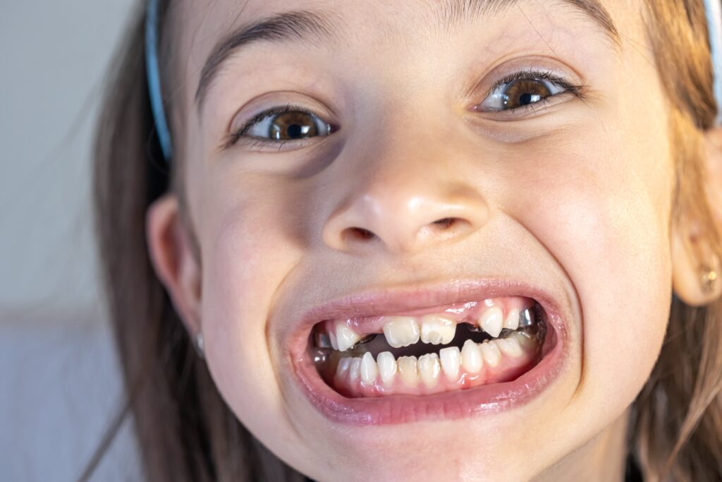 niña con dientes manchados y gastados por el consumo de gluten